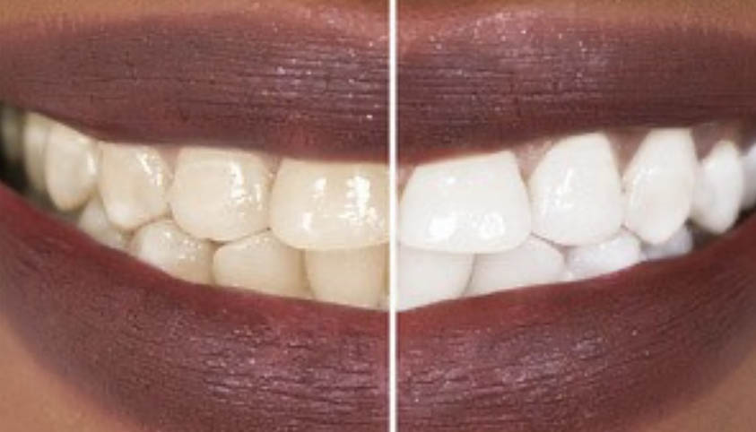 How To Remove Deep Brown Stains From Your Teeth With These Kitchen Ingredients