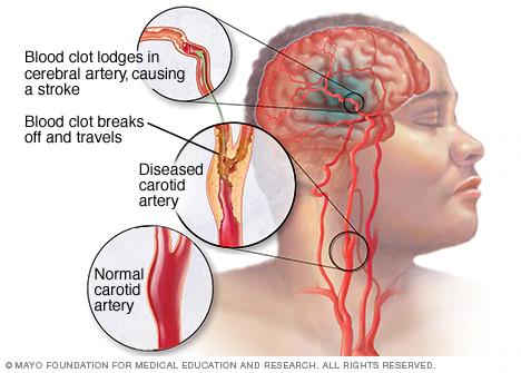 If You Don’t Want To Suffer Stroke At Old Age, Avoid Excess Intake Of These 3 Things